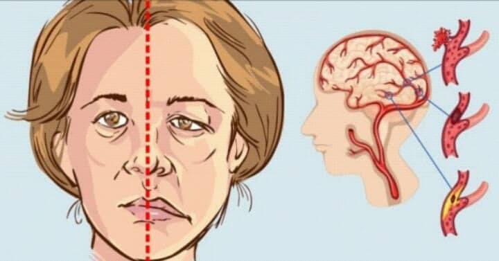 10 علامات تحدث قبل السكتة الدماغية..لا تتجاهلوها