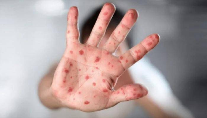 هكذا  تحمي نفسك من جدري القردة
