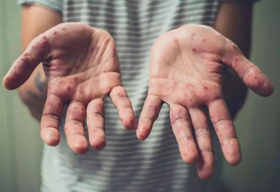 جدري القرود.. ما فترة حضانة الفيروس داخل جسم المصاب؟