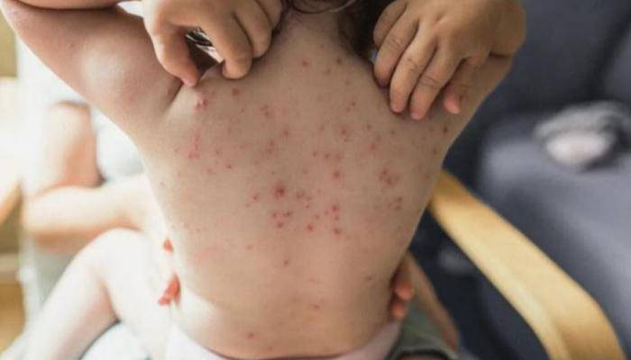 وسط خوف كبير.. منظمة الصحة ترفع درجة تهديد جدري القرود