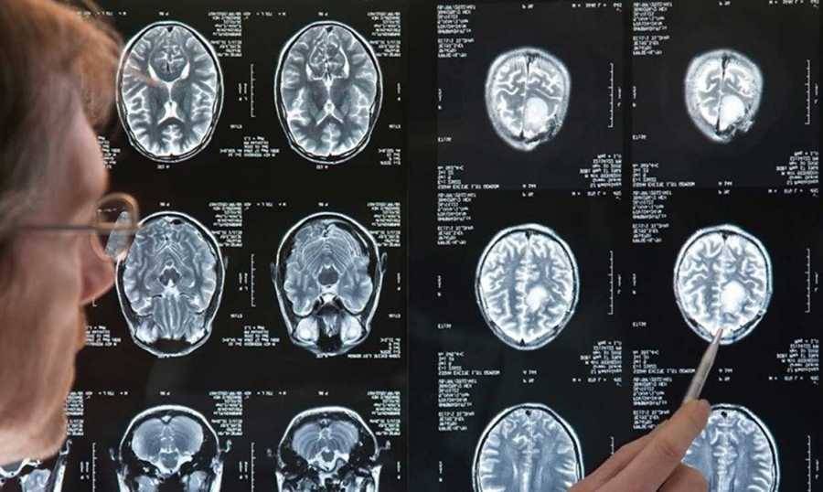 أورام الدماغ.. أكثر أنواع السرطانات فتكاً