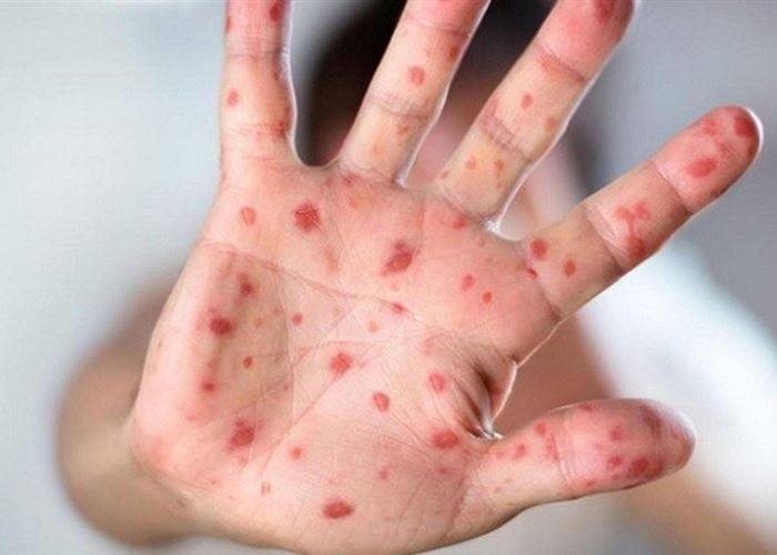 هل انتهى؟.. 5 أسئلة مهمة حول جدري القرود