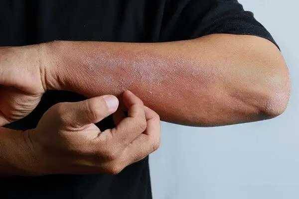 إنكلترا تسجل 94 وفاة بالحمى القرمزية